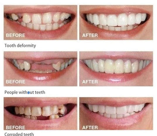 CARILLAS DENTALES+ ENVIO GRATIS