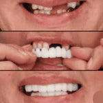 CARILLAS DENTALES+ ENVIO GRATIS
